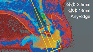 정확한 골밀도 파악